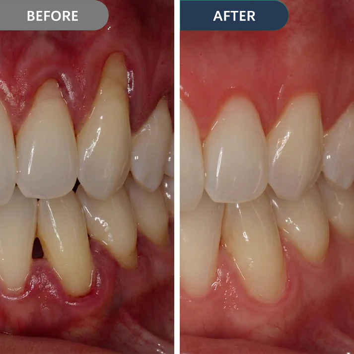 🏆 Official Store |SmileFitPro™ Precision Gum Care Gel